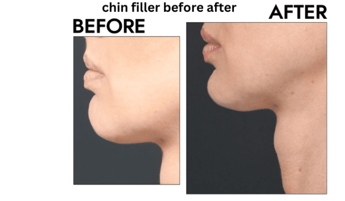 chin filler before after